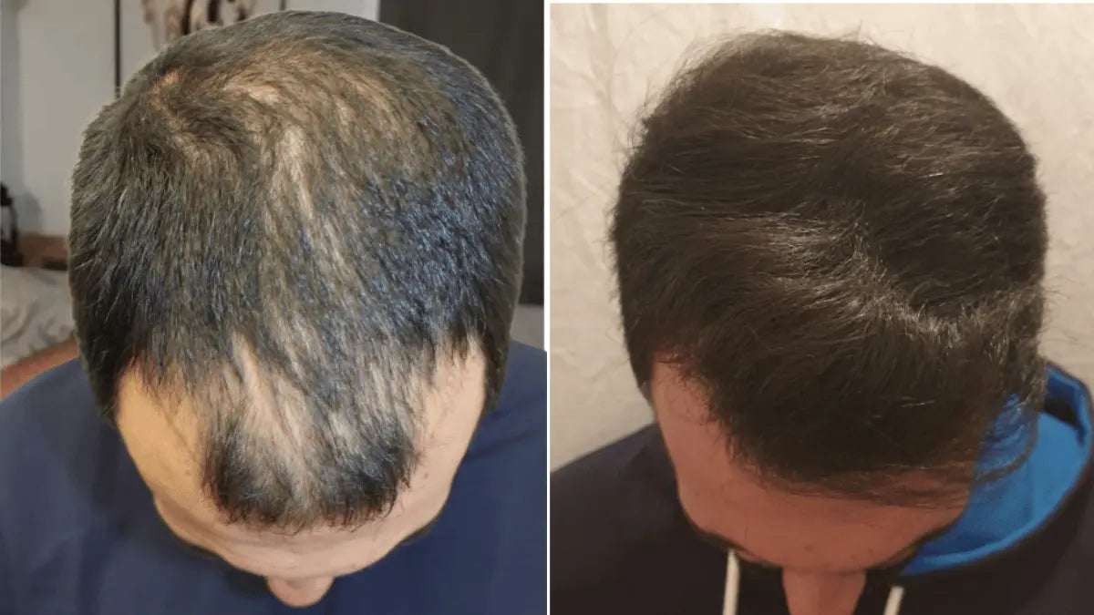 Before and after comparison of hair regrowth on a man's scalp.