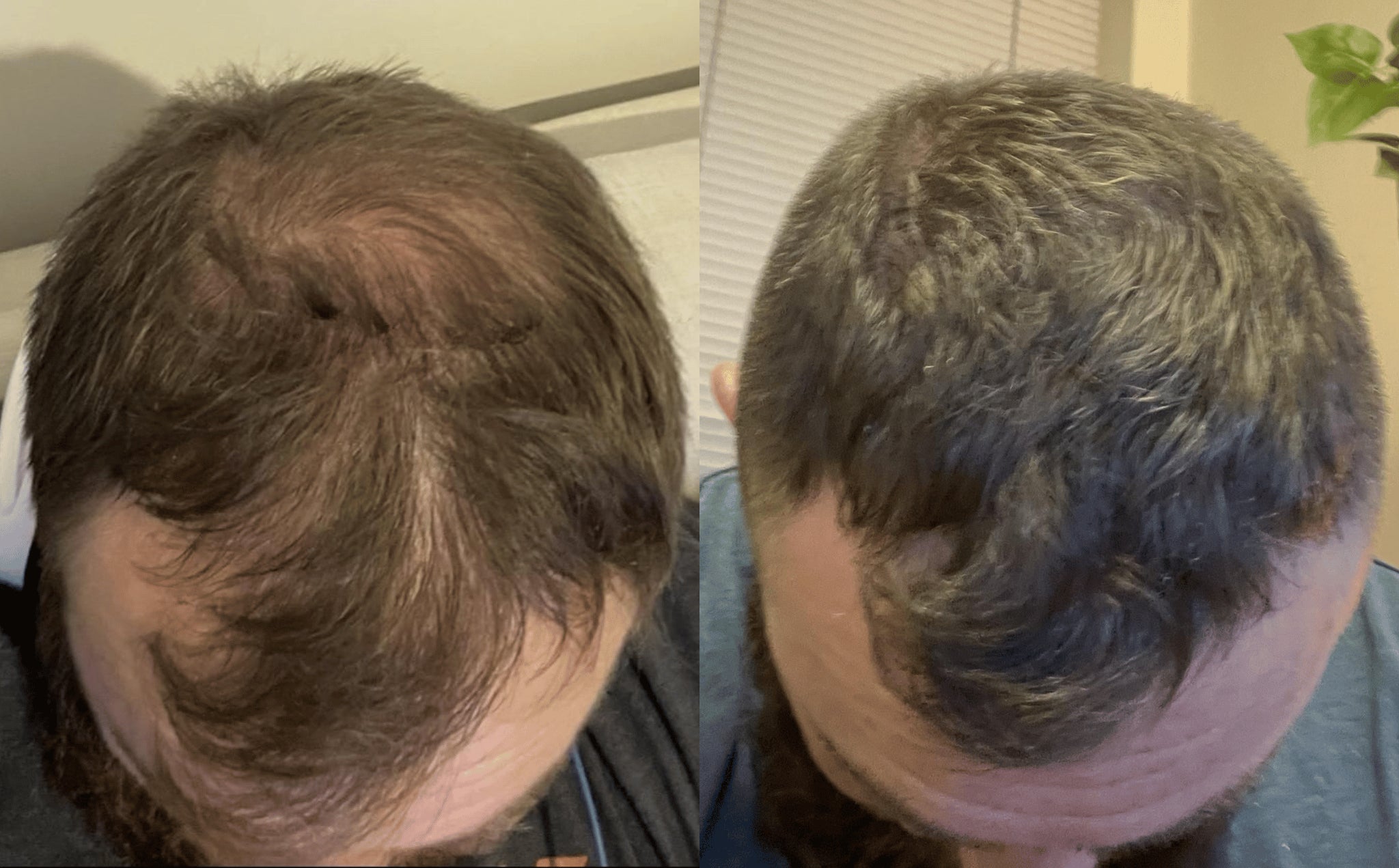 Two images showing top views of a person's head before and after hair treatment.