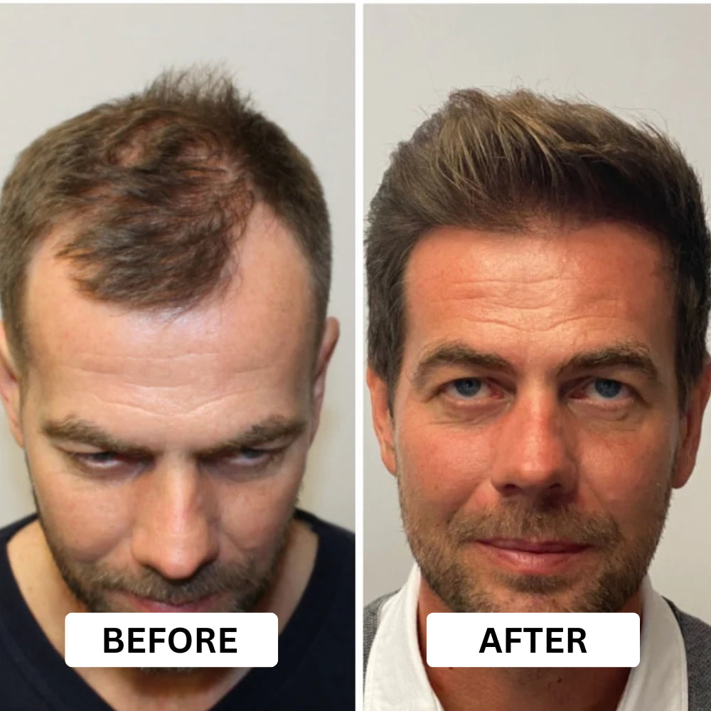 Before and after hair restoration treatment on a man's head.