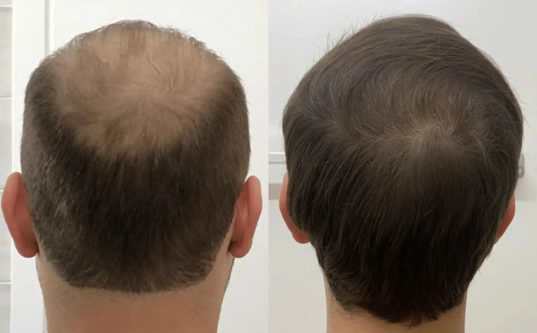 Two side-by-side images showing a bald and a fuller-haired head from the back.