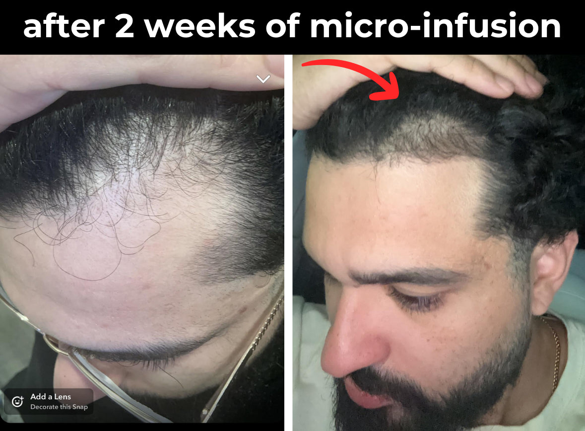 Before and after photos of hair regrowth treatment, showing visible improvement after two weeks.